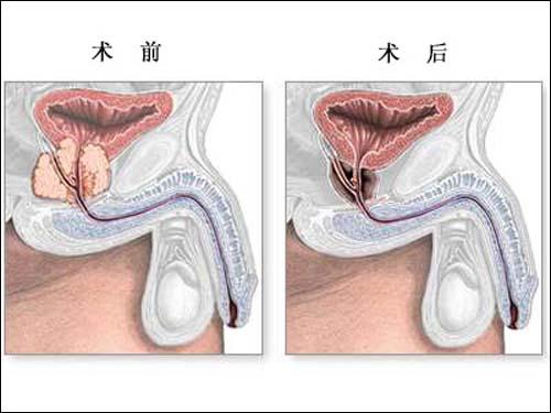 前列腺按摩方法
