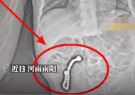 2岁女童误吞23颗磁力珠 医生：随时可能发生肠穿孔！