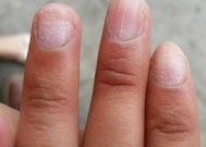 脚上灰指甲的危害性有多严重 为什么脚会长灰指甲