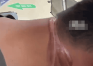 男子骑车下班被拦路光纤线割喉受伤：画面让人后怕！