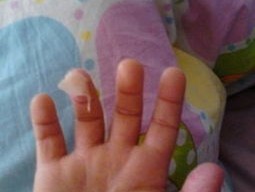 小孩子手指头脱皮发红痛（儿童手指头脱皮）