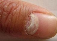 好多人灰指甲都不治正常吗 灰指甲不治疗会有什么后果