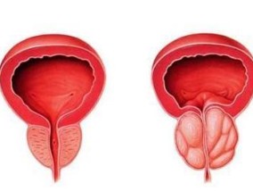 前列腺是哪里 前列腺是哪里的部位