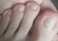 为什么年纪轻轻得了灰指甲正常吗 灰指甲几年了可以治好的吗