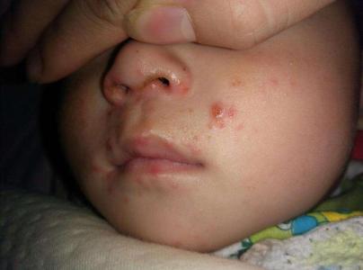 宝宝水痘图片早期婴儿图片